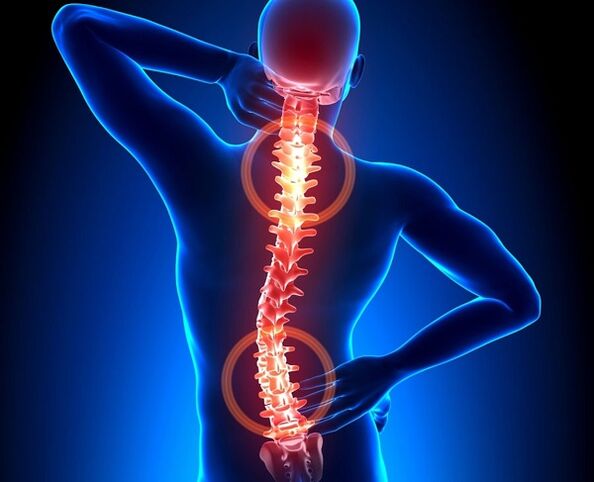 Douleur à la colonne vertébrale avec ostéochondrose