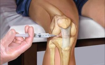injection intra-articulaire dans l'articulation dans l'arthrose