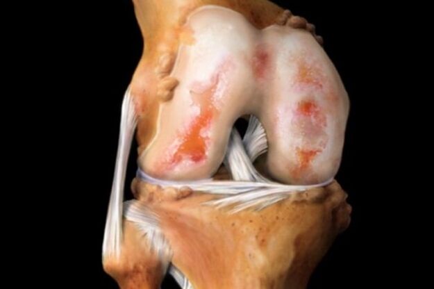 Dommages cartilagineux dans l'arthrose du genou