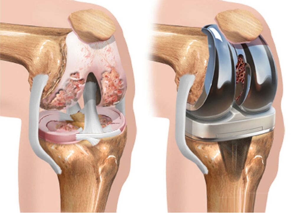 avant et après arthrose de l'articulation du genou dans l'arthrose