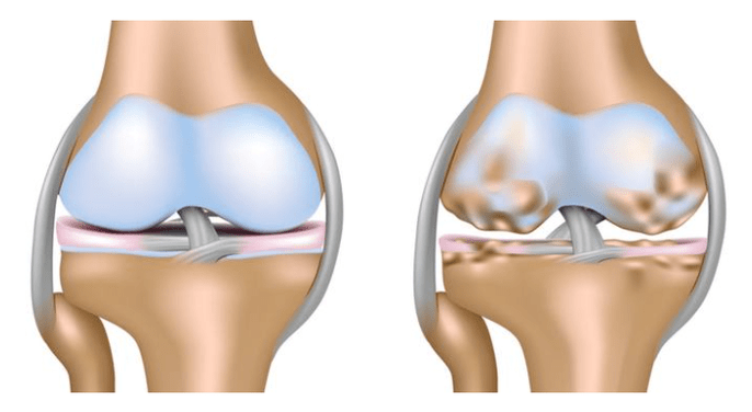 cartilage sain et dommages à l'articulation du genou dans l'arthrose