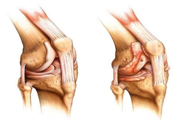 genou sain et arthrose de l'articulation du genou