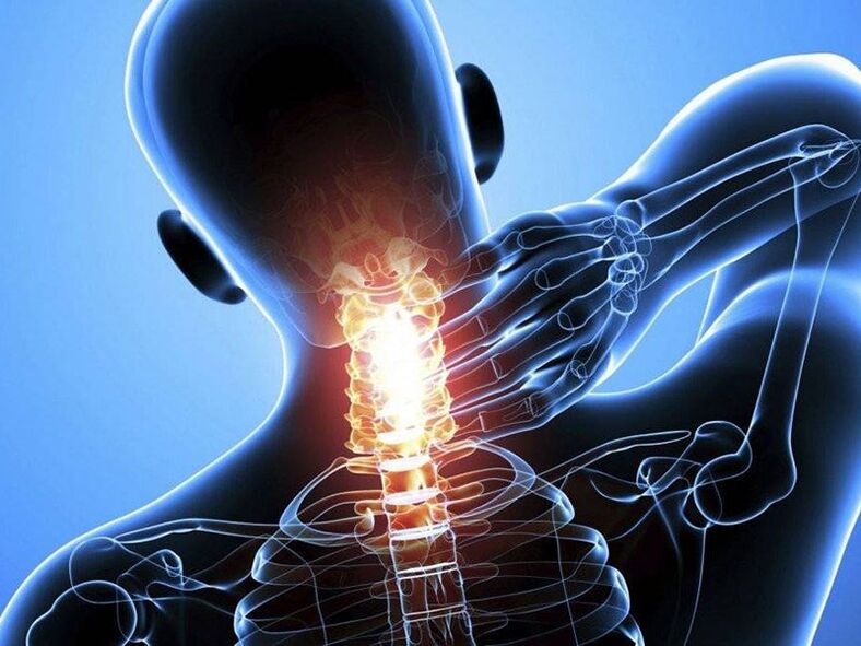 L'ostéochondrose de la colonne cervicale s'accompagne de douleurs au cou