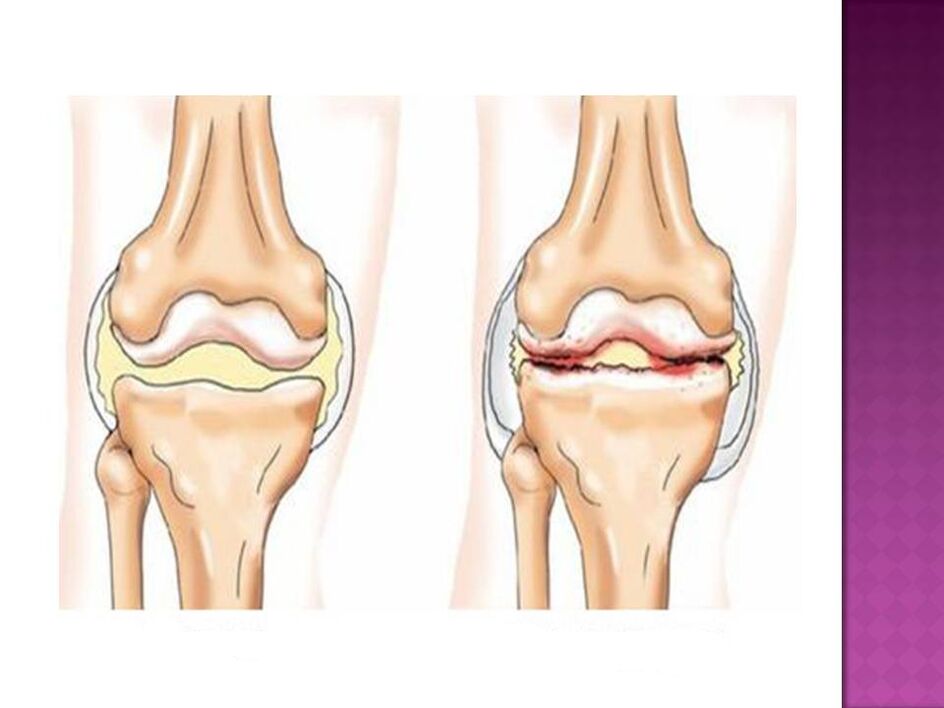 L'articulation est normale (gauche) et atteinte d'arthrose (droite)