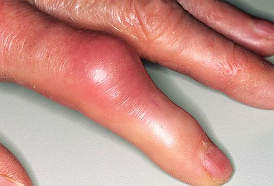 La goutte s'accompagne de fortes douleurs dans les doigts et d'un gonflement des articulations. 