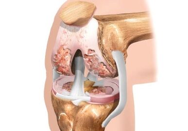 Dommages à la cararthrose du genou