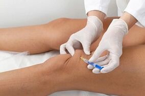 Injections dans l'articulation du genou pour l'arthrose